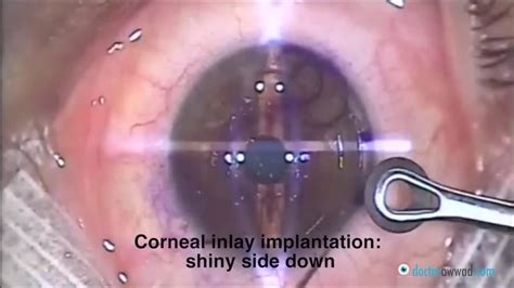Experience Life-Changing Vision with Corneal Inlays Surgery: Discover Your Options with an Optometrist